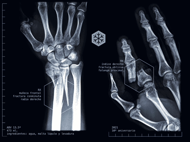 Fracture